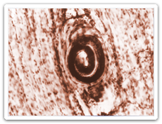 Trichinellosis (Trichinella) Trichinellosis (Trichinella)