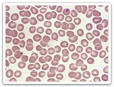 Babesia microti within peripheral blood smear
