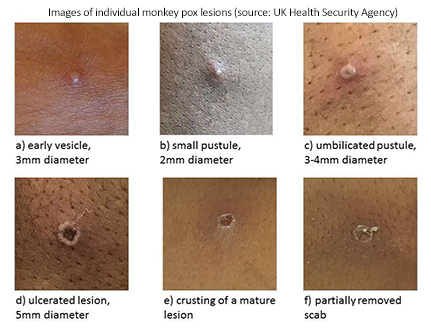 Images of individual monkey pox lesions (source: UK Health Security Agency).