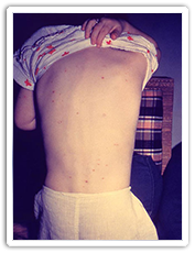Back of child with rash due to chickenpox
